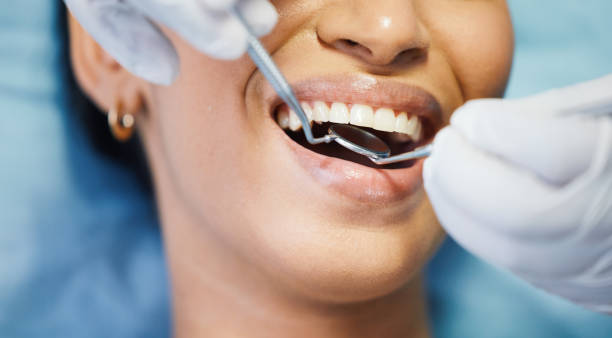 Best Lost Filling or Crown Replacement in Strawberry, CA